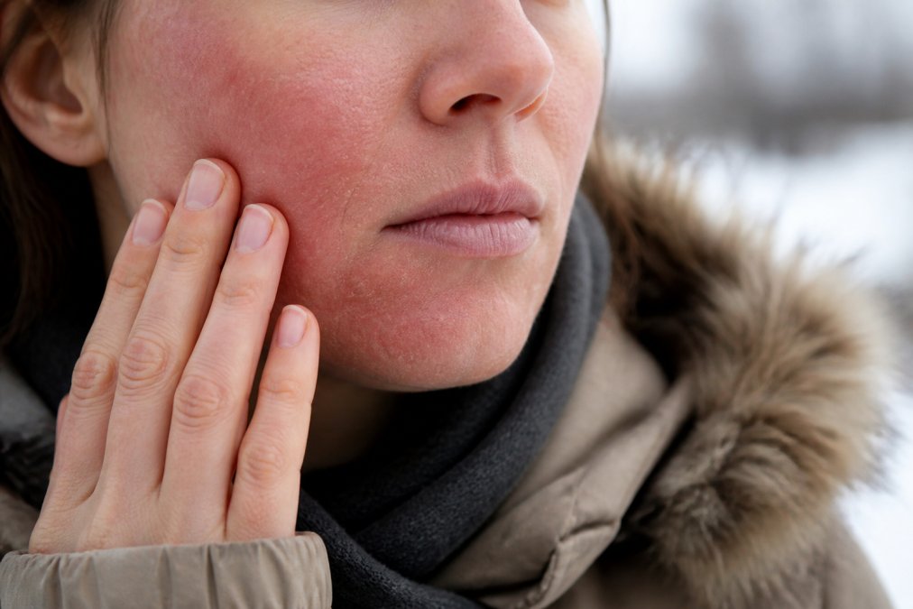 Damaged Skin Barrier From Cold Weather: 10 Signs
